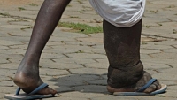 Plus d&rsquo;un milliard de personnes dans le monde souffrent de maladies tropicales n&eacute;glig&eacute;es dans le monde (OMS)