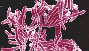 Les cas de tuberculose baissent trop lentement pour atteindre les objectifs fixés pour 2020