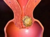 C&ocirc;te d&rsquo;Ivoire : 13 cas de cancer du col de l&rsquo;ut&eacute;rus confirm&eacute;s &agrave; Oum&eacute;