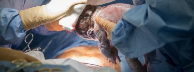 Une c&eacute;sarienne pratiqu&eacute;e &agrave; la maternit&eacute; de Chamb&eacute;ry (Savoie, France), le 11 d&eacute;cembre 2017