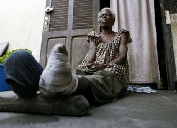 Une personne vivant avec la lèpre en Côte d&#039;Ivoire