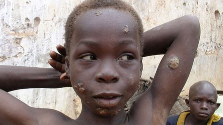 Côte d’Ivoire/ Maladie_Pian : les enfants sont les plus exposés (Résultats enquête)