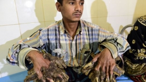 Abul Bajandar avant son opération, le 31 janvier 2016.MUNIR UZ ZAMAN / AFP/Source : http://www.rfi.fr 