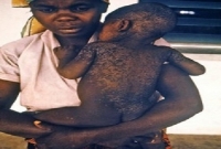 Alerte!!! Une &eacute;pid&eacute;mie de rougeole s&eacute;vit en Guin&eacute;e, voisin de la C&ocirc;te d'Ivoire